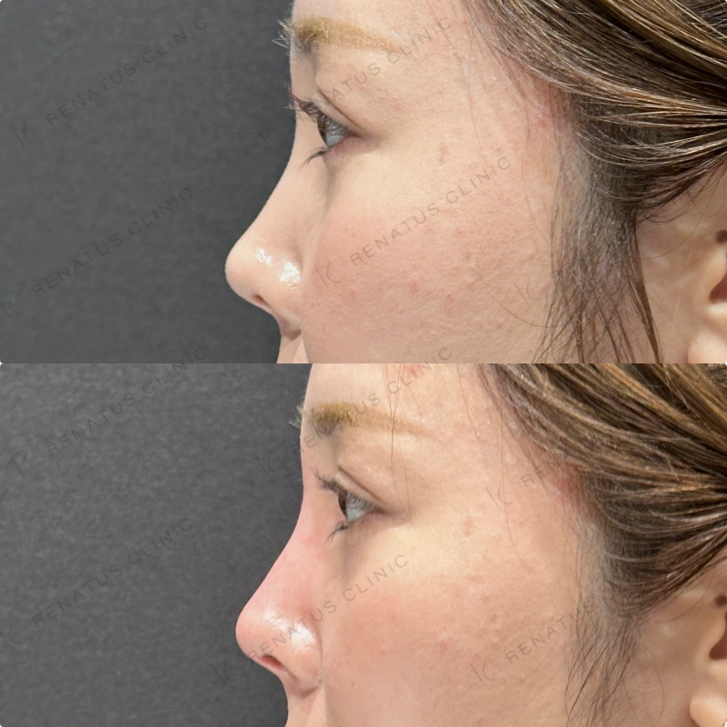 鼻根・鼻筋・鼻中隔ヒアルロン酸ボラックス症例写真