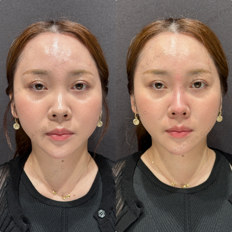 鼻根・鼻筋・鼻中隔ヒアルロン酸ボラックス症例写真