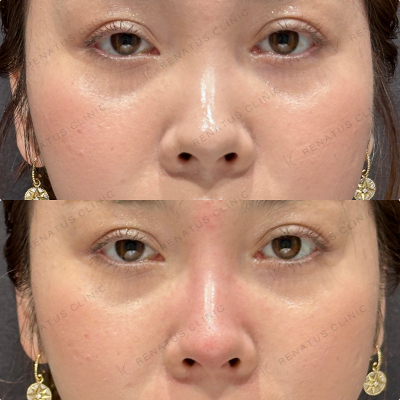 鼻根・鼻筋・鼻中隔ヒアルロン酸ボラックス症例写真