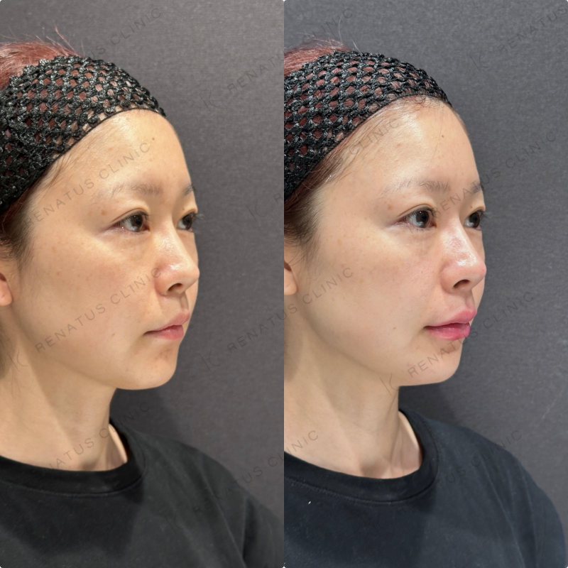 鼻筋・鼻中隔・鼻先・上唇・Cカール・下唇ヒアルロン酸ボラックス・ボルベラ症例写真