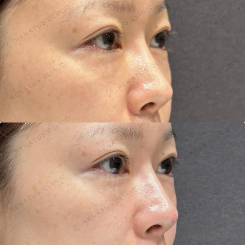 鼻筋・鼻中隔・鼻先・上唇・Cカール・下唇ヒアルロン酸ボラックス・ボルベラ症例写真