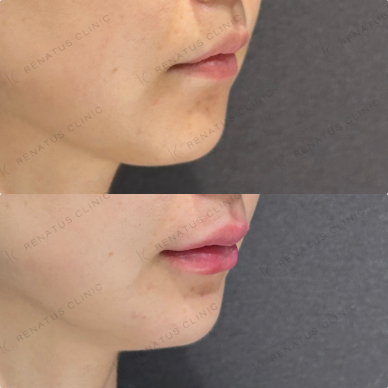 鼻筋・鼻中隔・鼻先・上唇・Cカール・下唇ヒアルロン酸ボラックス・ボルベラ症例写真