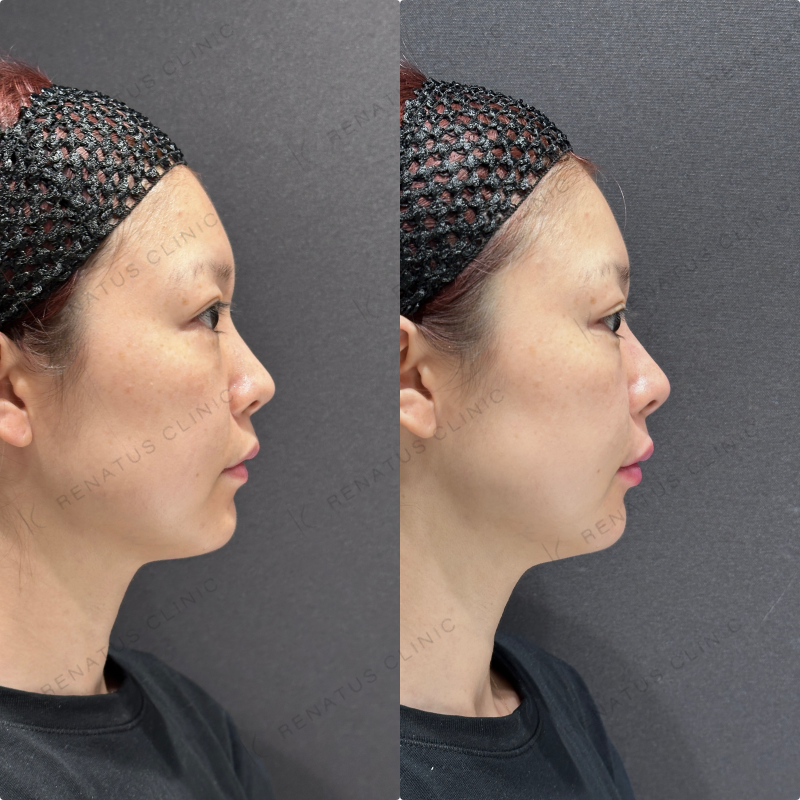 鼻筋・鼻中隔・鼻先・上唇・Cカール・下唇ヒアルロン酸ボラックス・ボルベラ症例写真