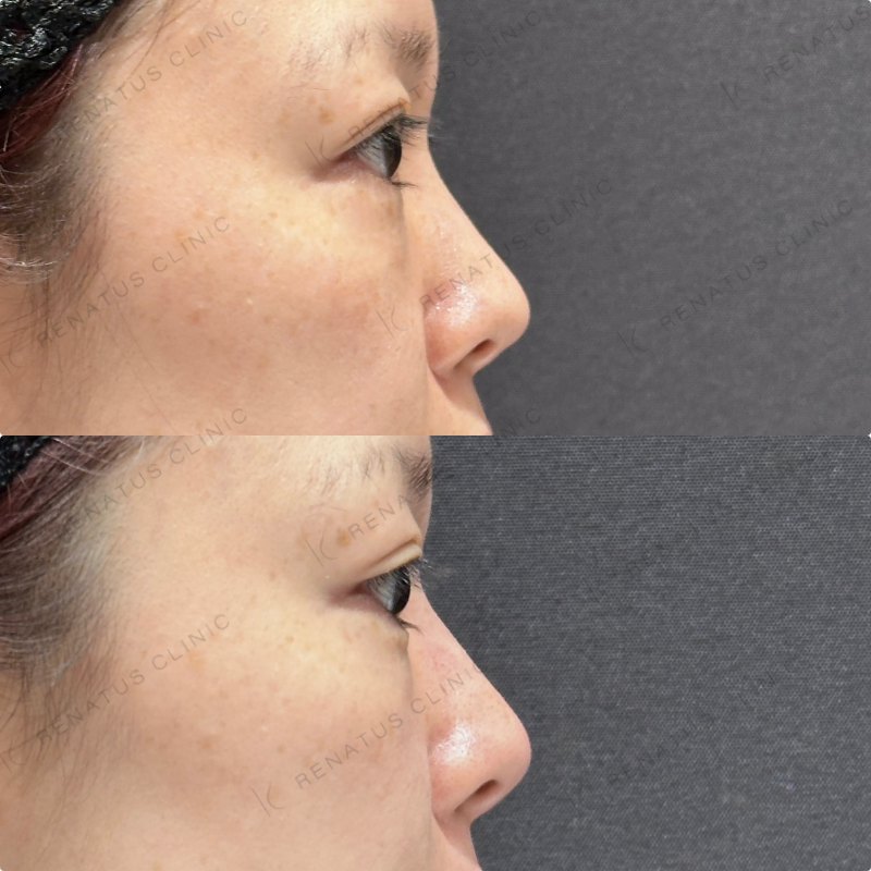 鼻筋・鼻中隔・鼻先・上唇・Cカール・下唇ヒアルロン酸ボラックス・ボルベラ症例写真