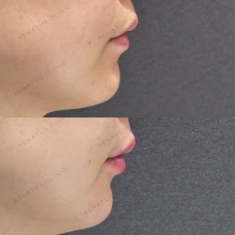 鼻筋・鼻中隔・鼻先・上唇・Cカール・下唇ヒアルロン酸ボラックス・ボルベラ症例写真
