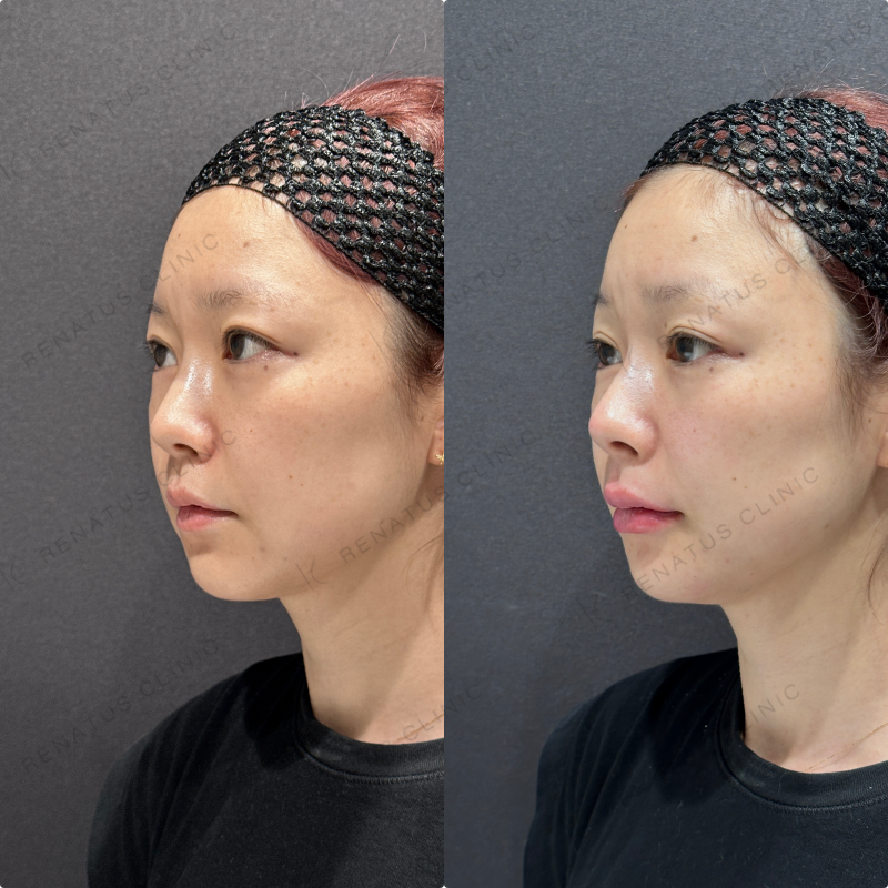 鼻筋・鼻中隔・鼻先・上唇・Cカール・下唇ヒアルロン酸ボラックス・ボルベラ症例写真