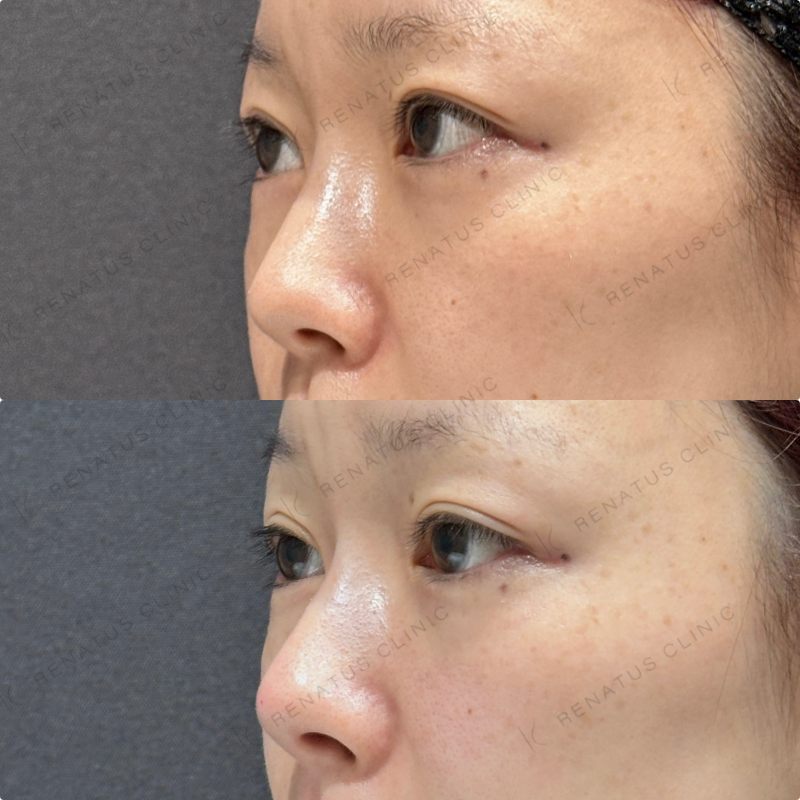 鼻筋・鼻中隔・鼻先・上唇・Cカール・下唇ヒアルロン酸ボラックス・ボルベラ症例写真