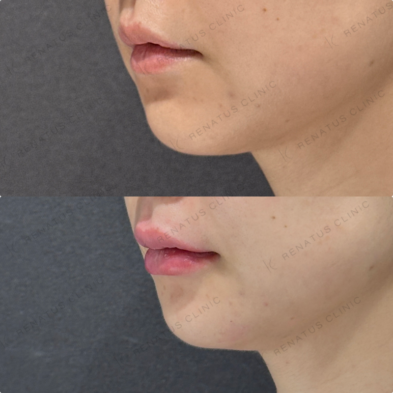 鼻筋・鼻中隔・鼻先・上唇・Cカール・下唇ヒアルロン酸ボラックス・ボルベラ症例写真