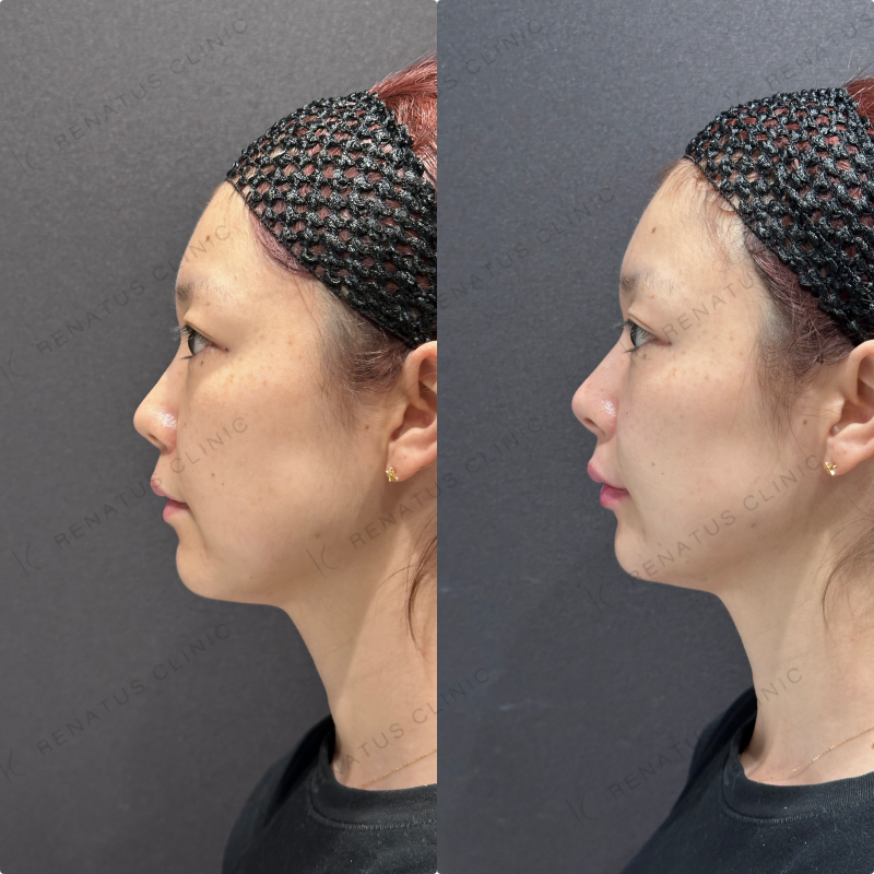 鼻筋・鼻中隔・鼻先・上唇・Cカール・下唇ヒアルロン酸ボラックス・ボルベラ症例写真