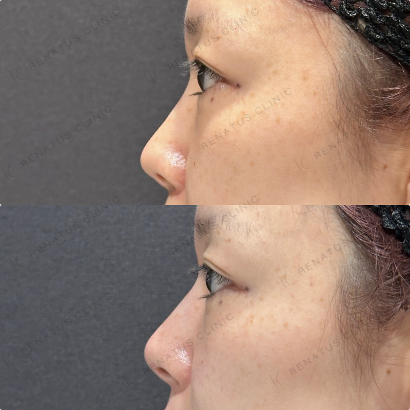 鼻筋・鼻中隔・鼻先・上唇・Cカール・下唇ヒアルロン酸ボラックス・ボルベラ症例写真