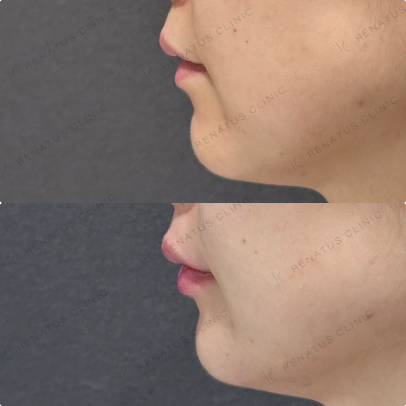 鼻筋・鼻中隔・鼻先・上唇・Cカール・下唇ヒアルロン酸ボラックス・ボルベラ症例写真