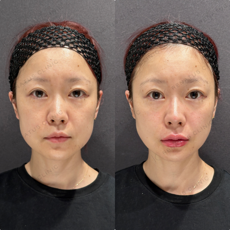 鼻筋・鼻中隔・鼻先・上唇・Cカール・下唇ヒアルロン酸ボラックス・ボルベラ症例写真