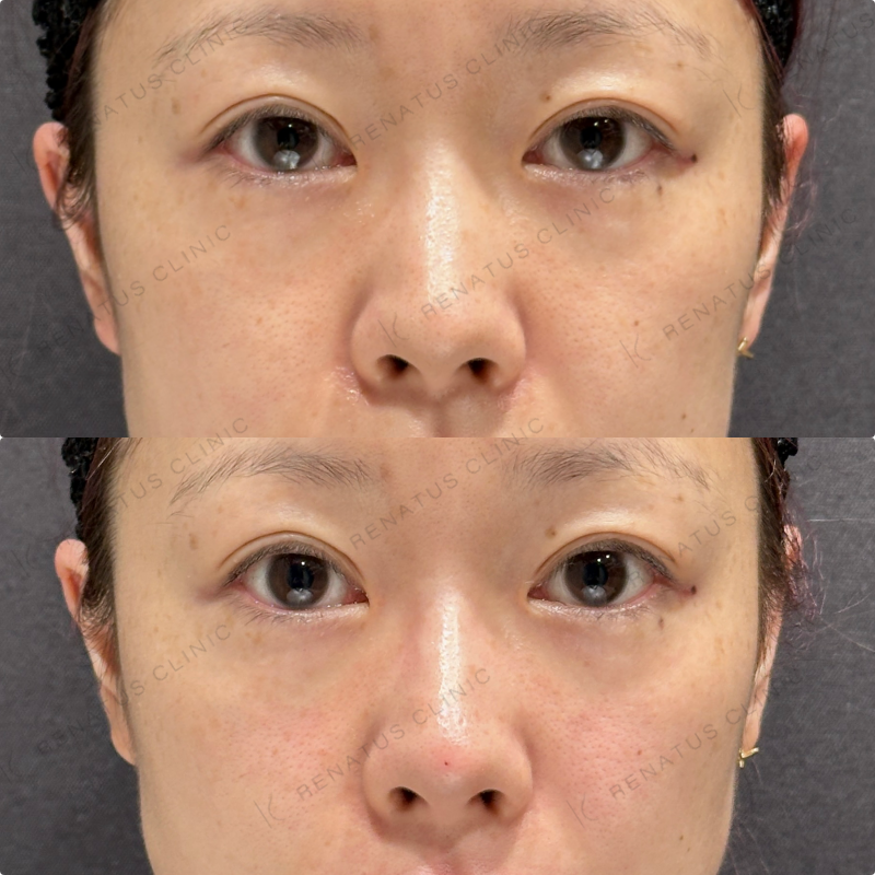 鼻筋・鼻中隔・鼻先・上唇・Cカール・下唇ヒアルロン酸ボラックス・ボルベラ症例写真