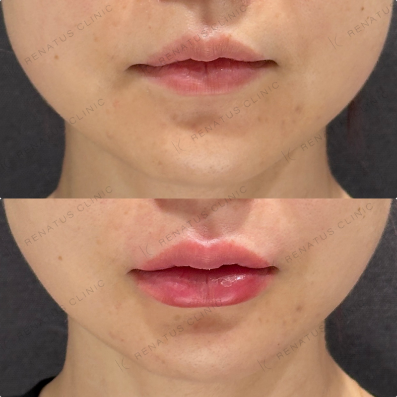 鼻筋・鼻中隔・鼻先・上唇・Cカール・下唇ヒアルロン酸ボラックス・ボルベラ症例写真