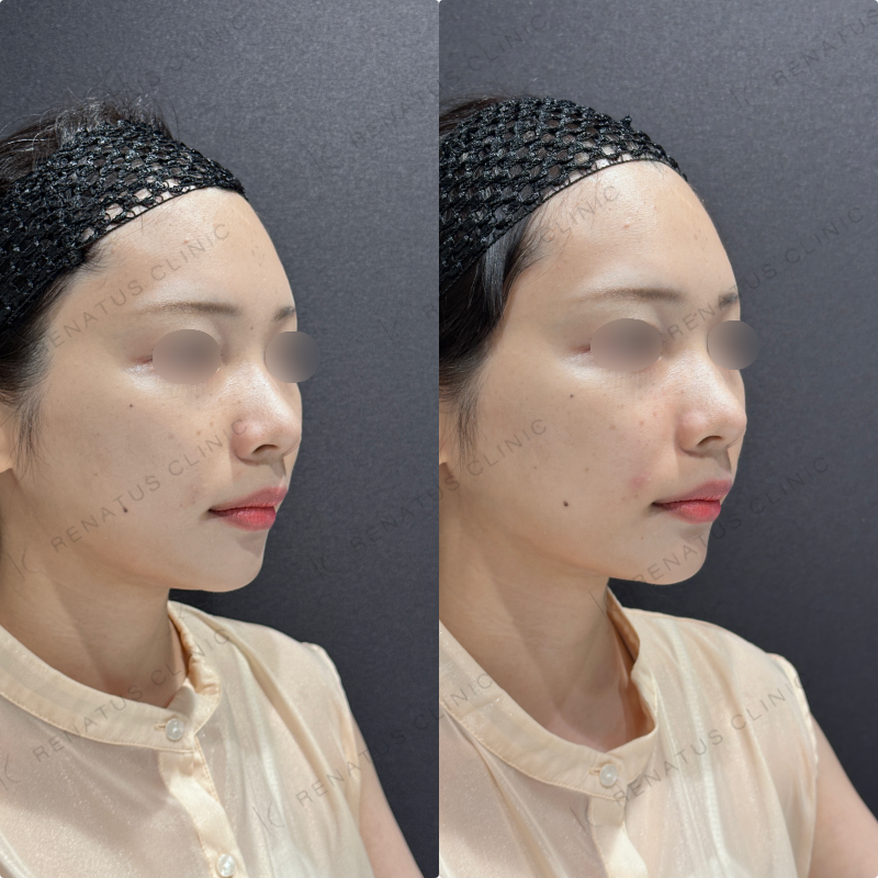 鼻翼基部ヒアルロン酸ボリフト症例写真