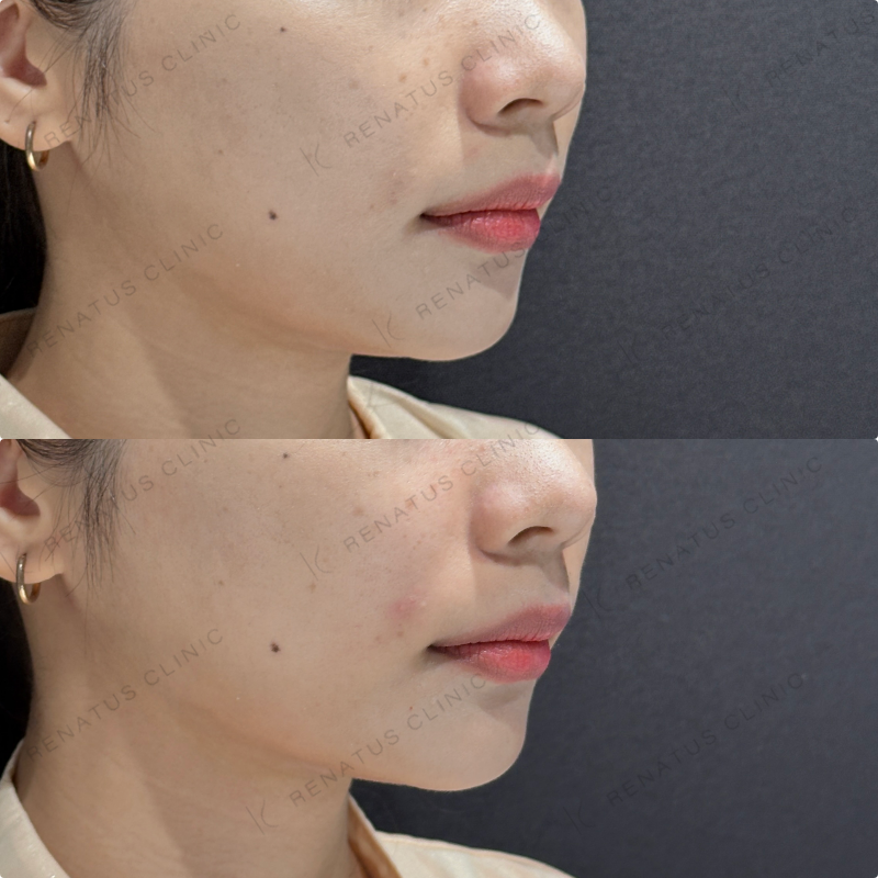 鼻翼基部ヒアルロン酸ボリフト症例写真