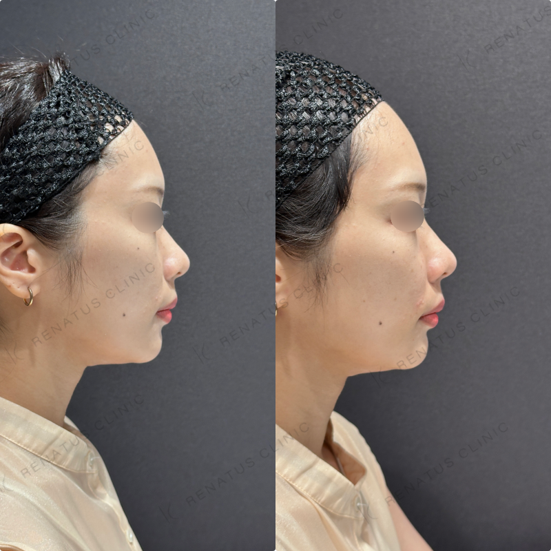 鼻翼基部ヒアルロン酸ボリフト症例写真