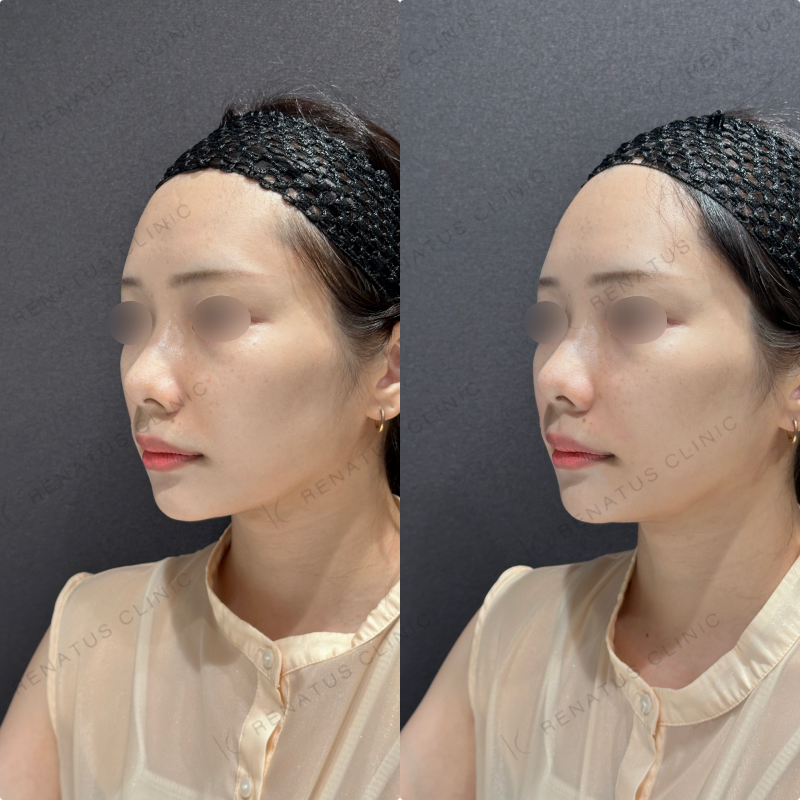 鼻翼基部ヒアルロン酸ボリフト症例写真