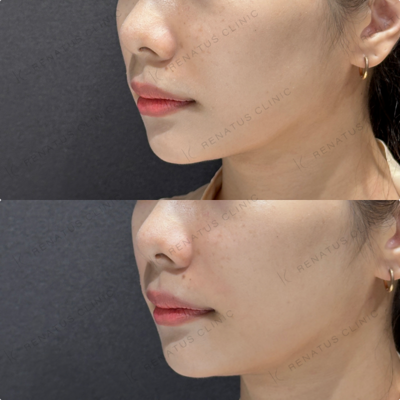 鼻翼基部ヒアルロン酸ボリフト症例写真