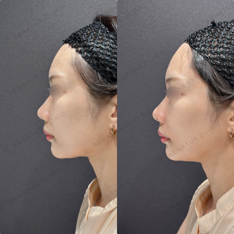 鼻翼基部ヒアルロン酸ボリフト症例写真