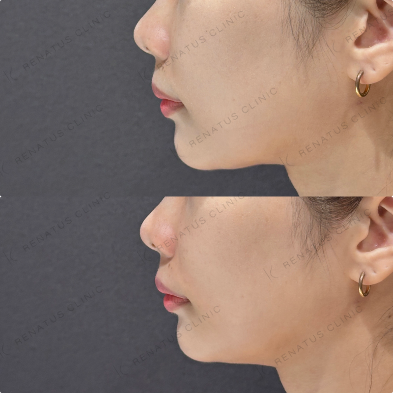 鼻翼基部ヒアルロン酸ボリフト症例写真