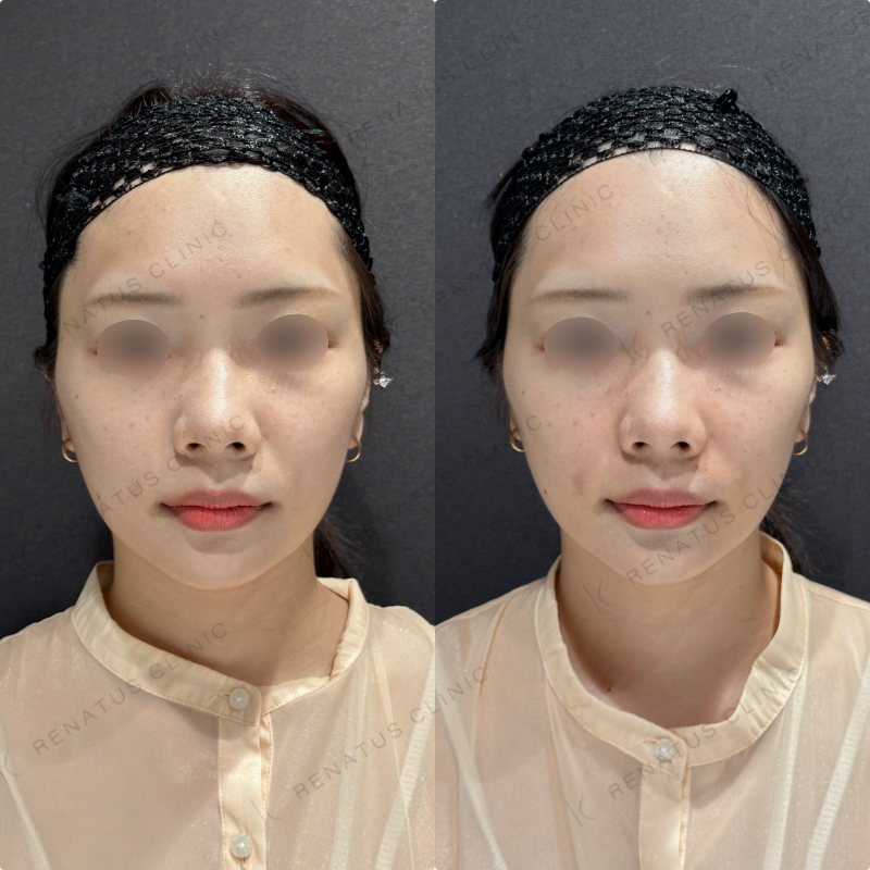 鼻翼基部ヒアルロン酸ボリフト症例写真