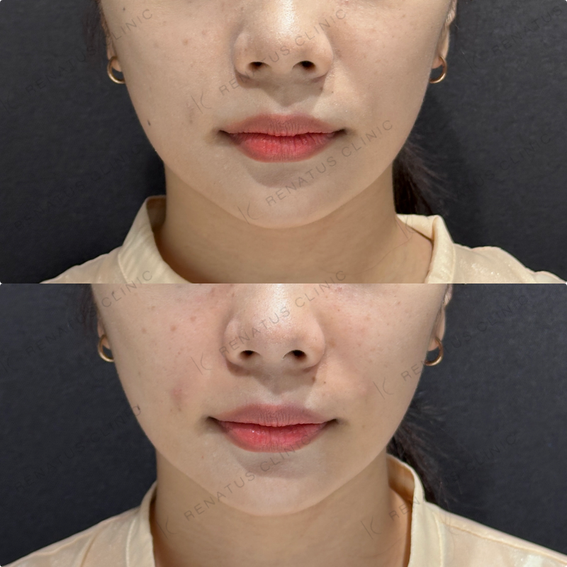 鼻翼基部ヒアルロン酸ボリフト症例写真