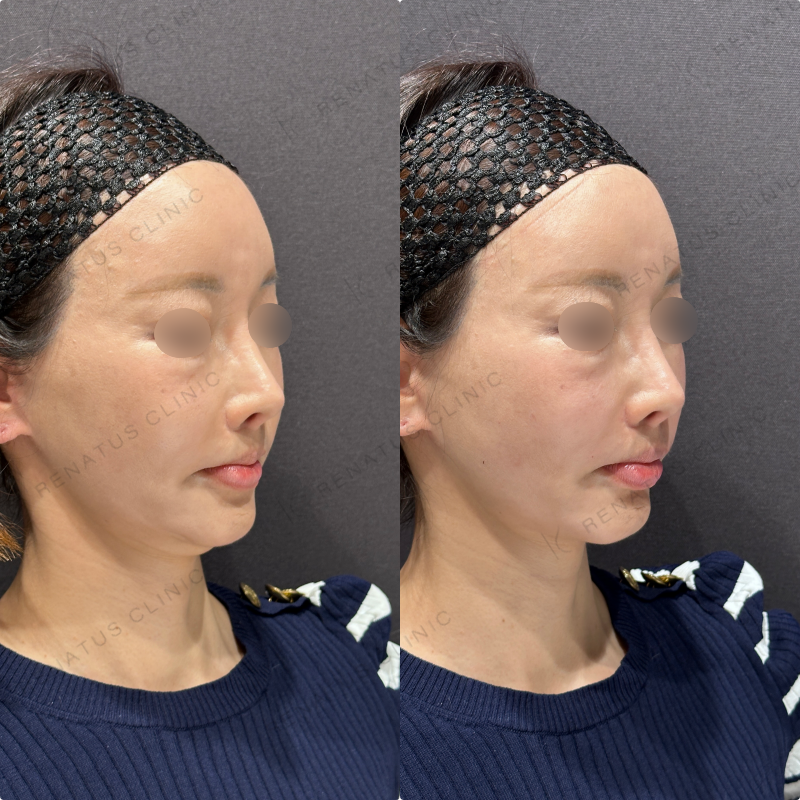 鼻翼基部ヒアルロン酸ボリューマ・ボリフト症例写真