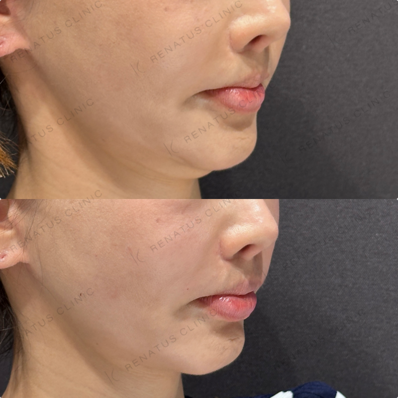 鼻翼基部ヒアルロン酸ボリューマ・ボリフト症例写真