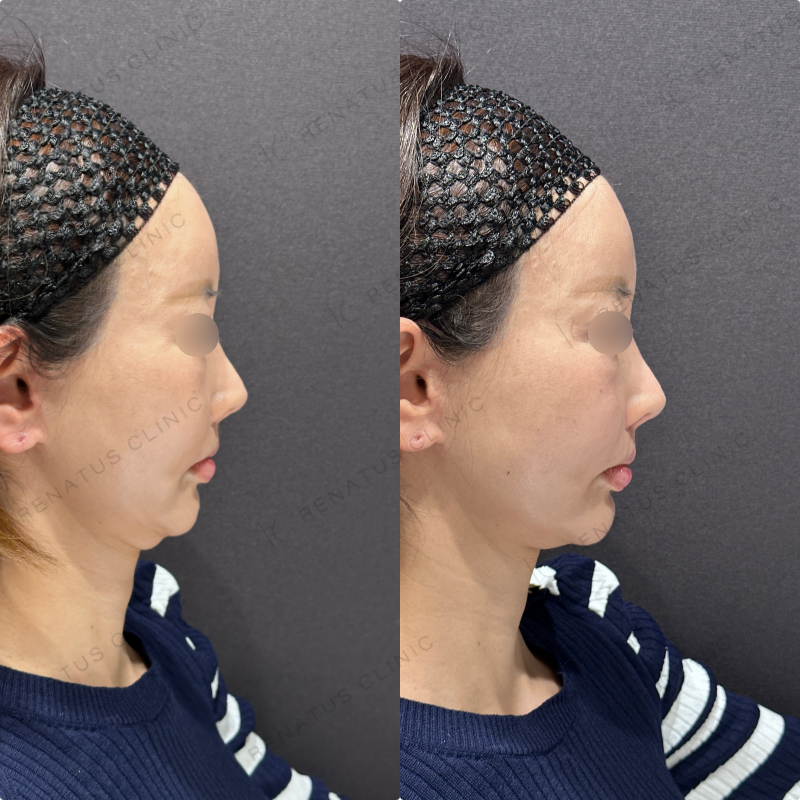 鼻翼基部ヒアルロン酸ボリューマ・ボリフト症例写真