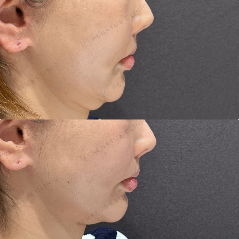 鼻翼基部ヒアルロン酸ボリューマ・ボリフト症例写真