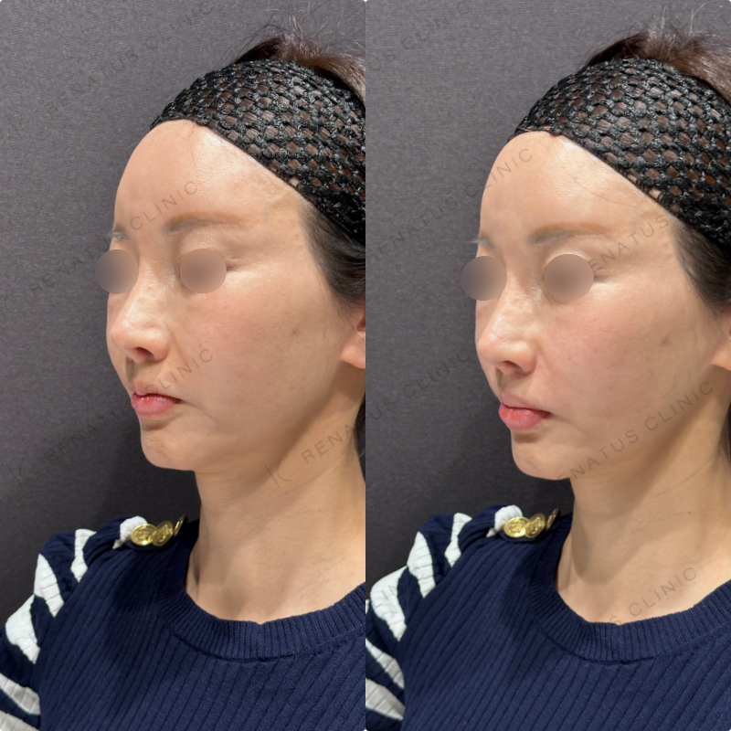 鼻翼基部ヒアルロン酸ボリューマ・ボリフト症例写真