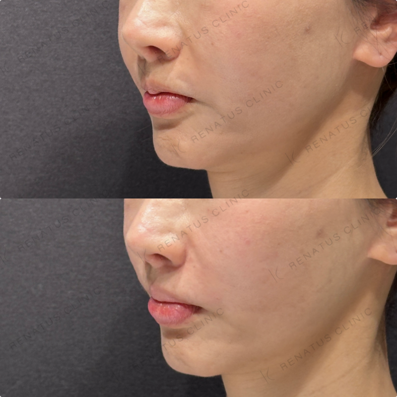 鼻翼基部ヒアルロン酸ボリューマ・ボリフト症例写真