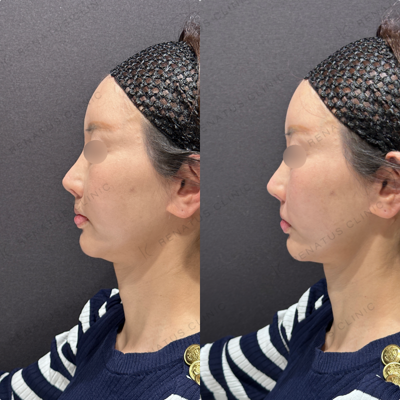 鼻翼基部ヒアルロン酸ボリューマ・ボリフト症例写真