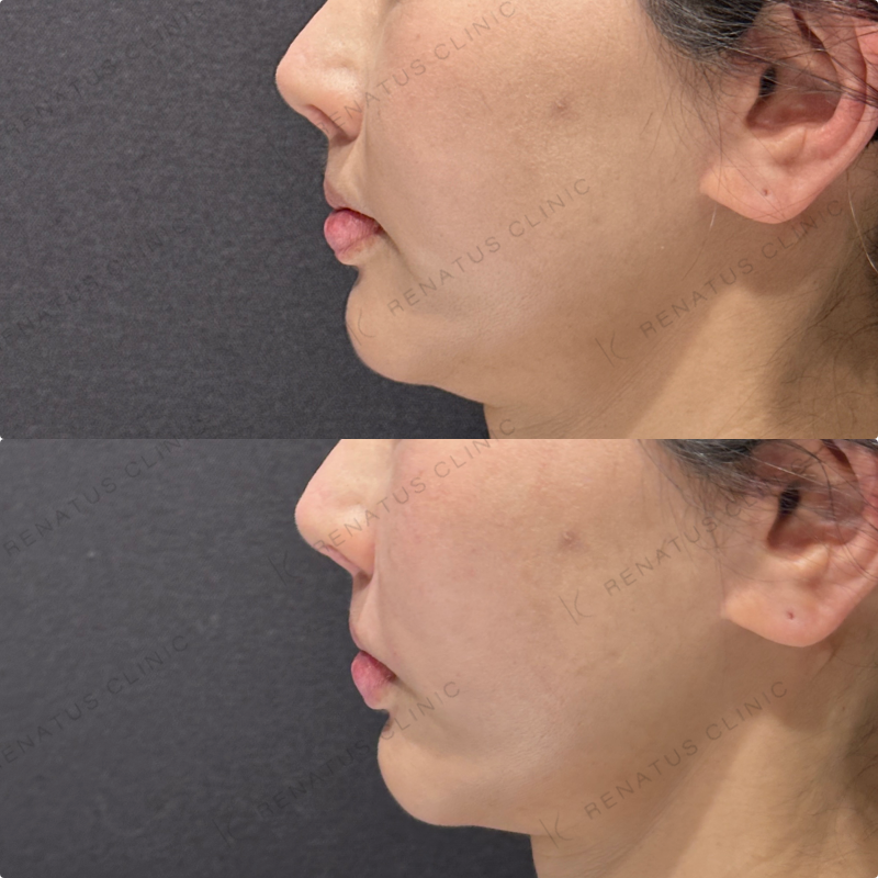 鼻翼基部ヒアルロン酸ボリューマ・ボリフト症例写真