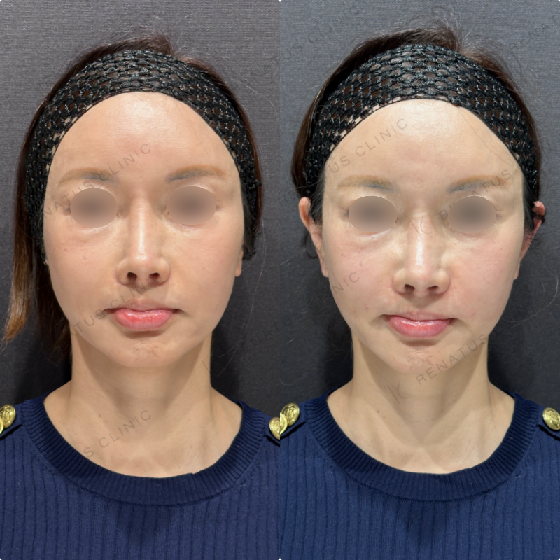 鼻翼基部ヒアルロン酸ボリューマ・ボリフト症例写真