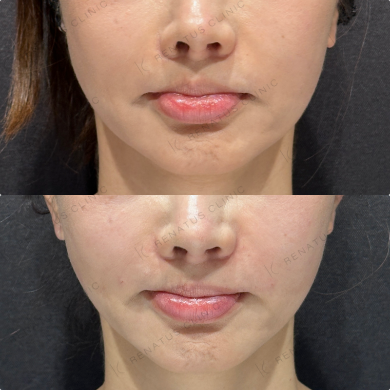 鼻翼基部ヒアルロン酸ボリューマ・ボリフト症例写真