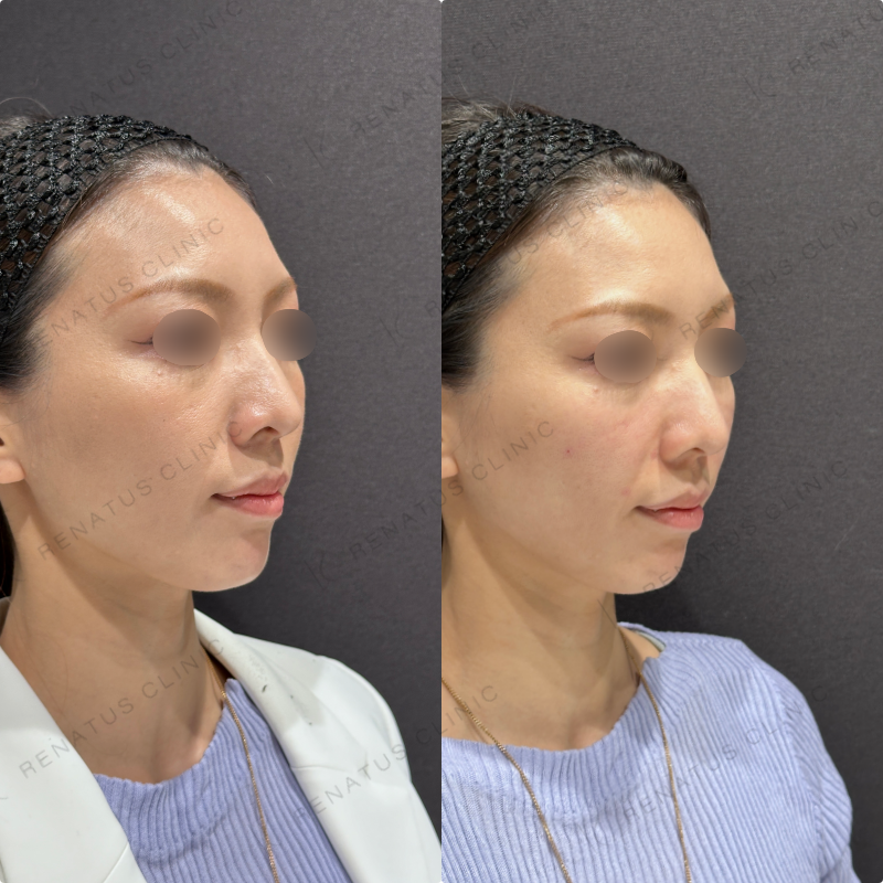 鼻翼基部・頬・ほうれい線ヒアルロン酸ボリューマ・ボリフト症例写真