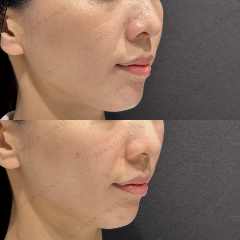 鼻翼基部・頬・ほうれい線ヒアルロン酸ボリューマ・ボリフト症例写真