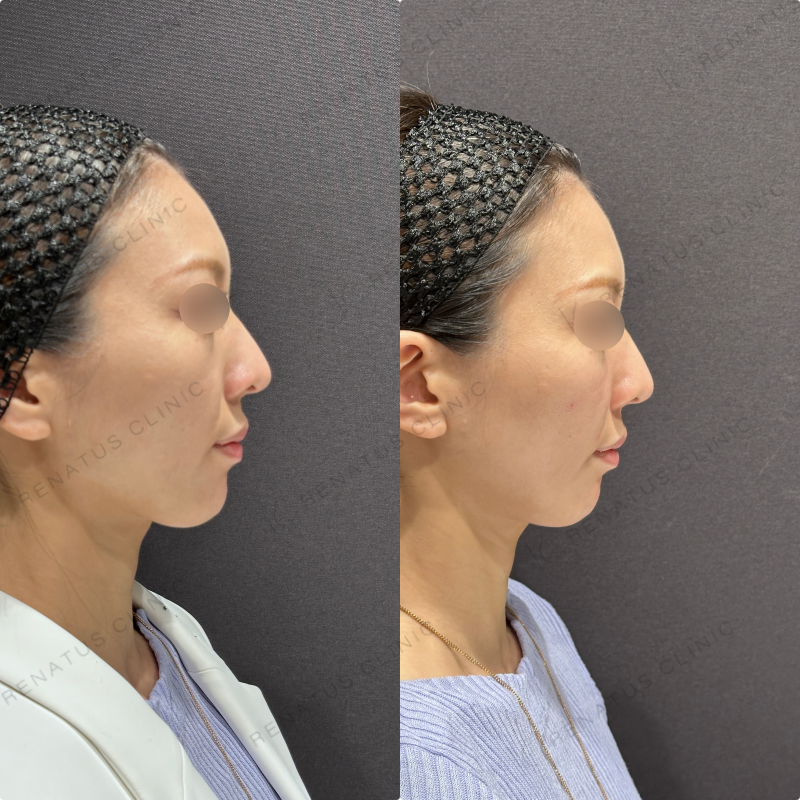 鼻翼基部・頬・ほうれい線ヒアルロン酸ボリューマ・ボリフト症例写真