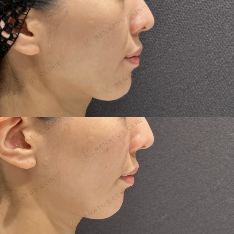 鼻翼基部・頬・ほうれい線ヒアルロン酸ボリューマ・ボリフト症例写真