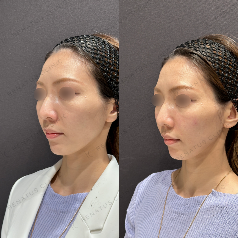 鼻翼基部・頬・ほうれい線ヒアルロン酸ボリューマ・ボリフト症例写真