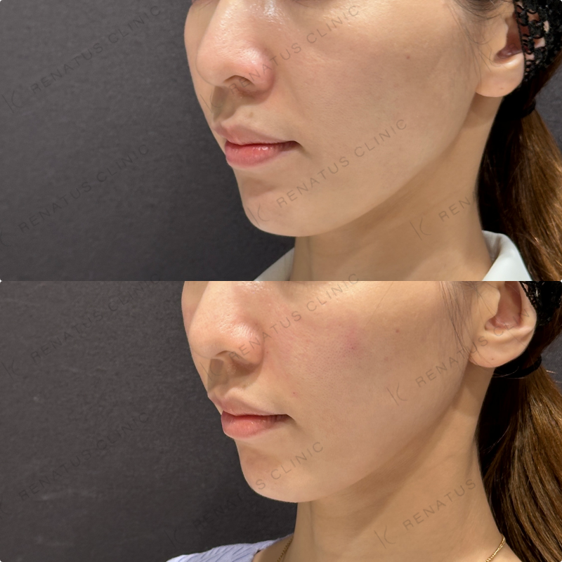 鼻翼基部・頬・ほうれい線ヒアルロン酸ボリューマ・ボリフト症例写真