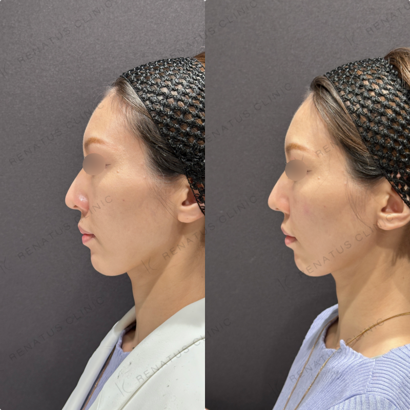 鼻翼基部・頬・ほうれい線ヒアルロン酸ボリューマ・ボリフト症例写真