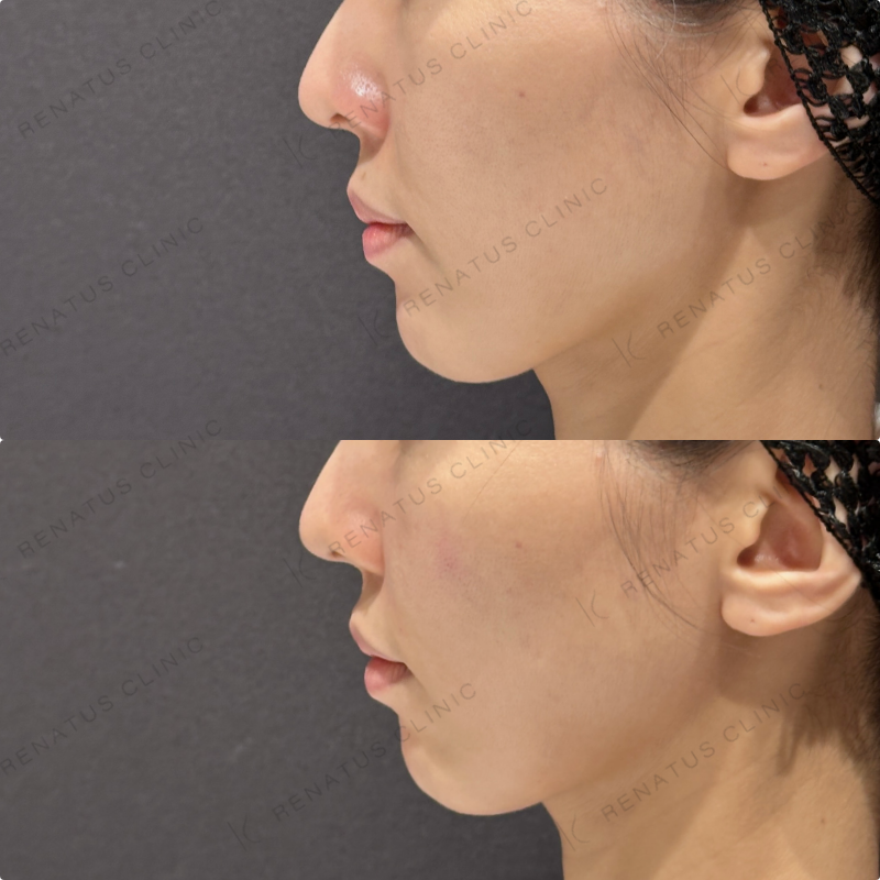 鼻翼基部・頬・ほうれい線ヒアルロン酸ボリューマ・ボリフト症例写真