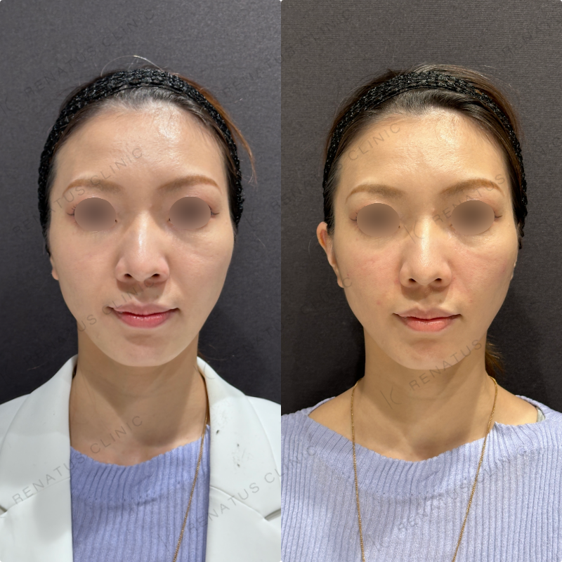 鼻翼基部・頬・ほうれい線ヒアルロン酸ボリューマ・ボリフト症例写真