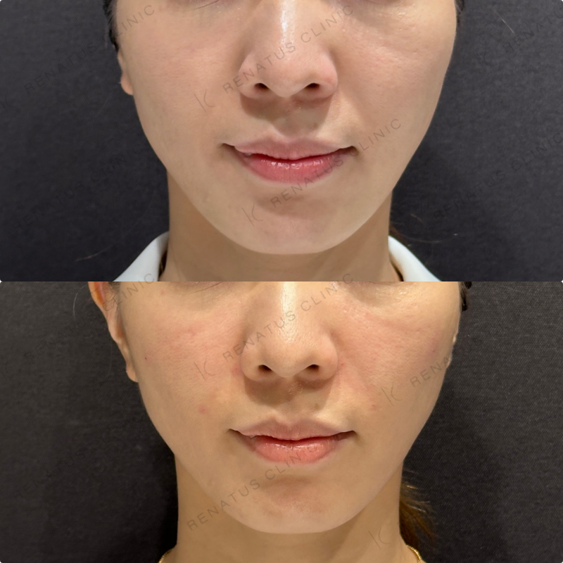 鼻翼基部・頬・ほうれい線ヒアルロン酸ボリューマ・ボリフト症例写真