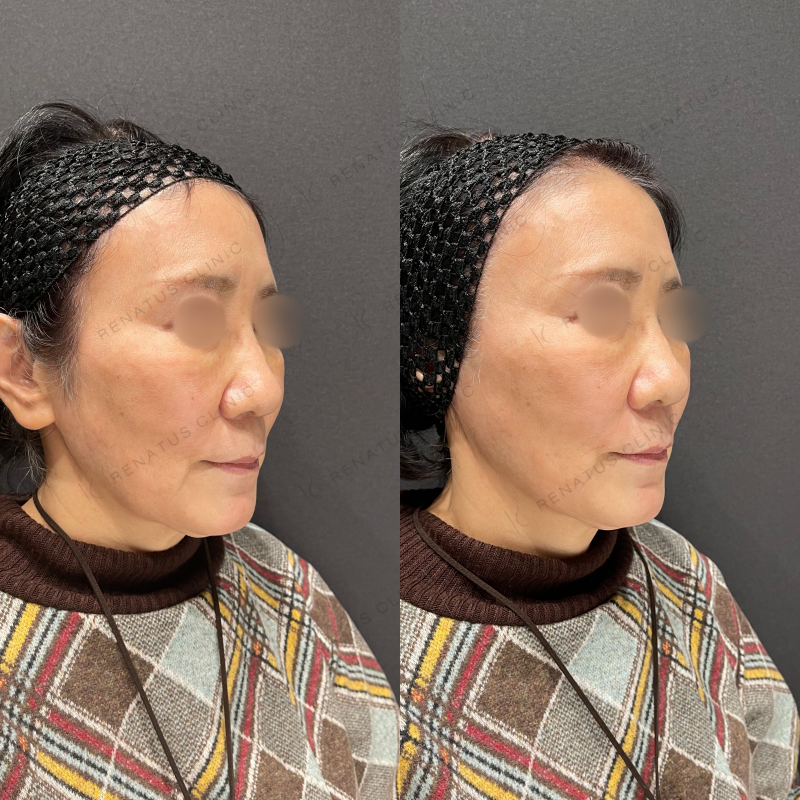 ほうれい線ヒアルロン酸ボリフト症例写真