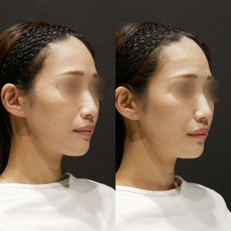 ほうれい線ヒアルロン酸ボリフト症例写真