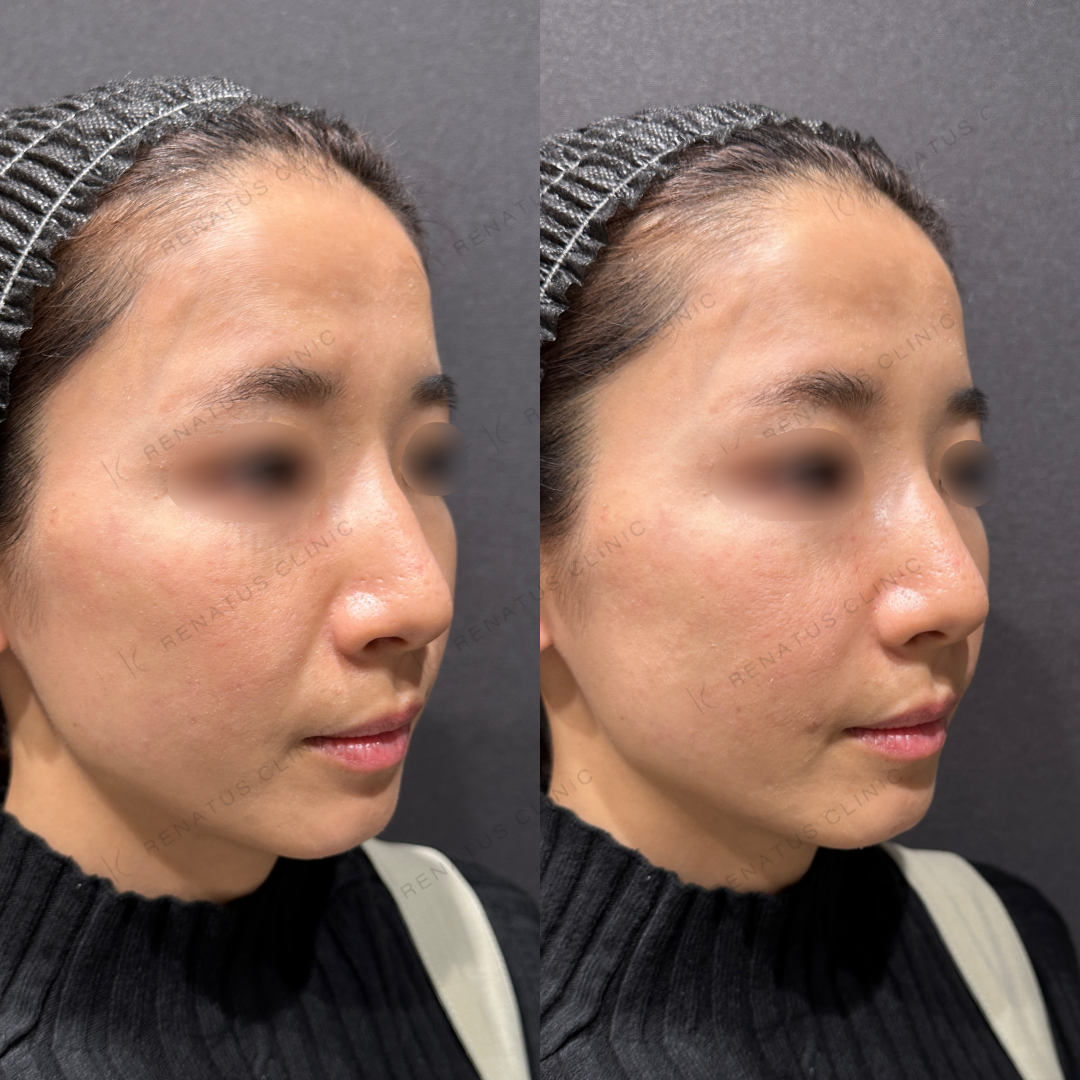 ほうれい線ヒアルロン酸ボリフト症例写真